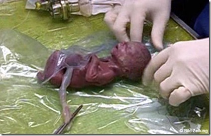 Kimberly Mueller, World's Tiniest Baby
